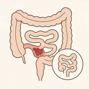 Maladie de Crohn